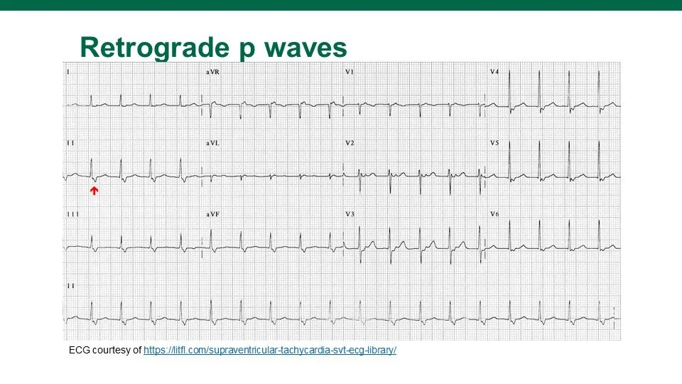 SVT on the ECG! — USF Emergency Medicine